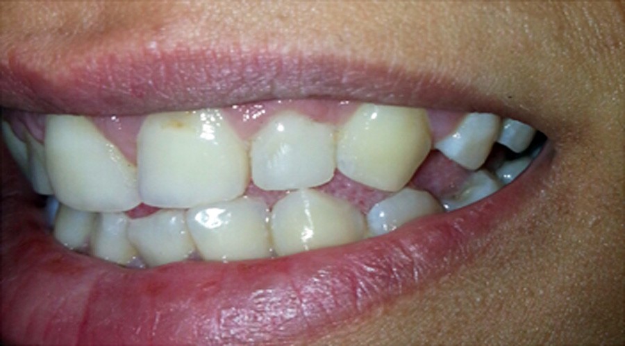 بعد تجميل الاسنان والحشوات التجميل 2